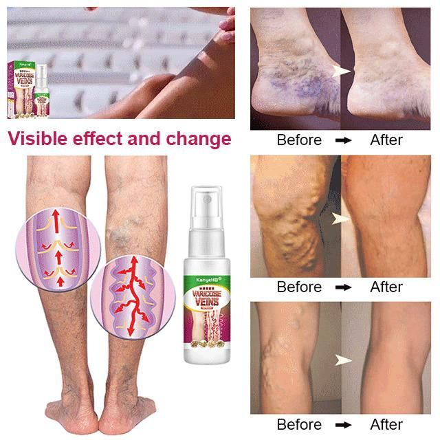 Vein Healing Varicose Veins Treatment Spray 50ml (Pack Of 2)