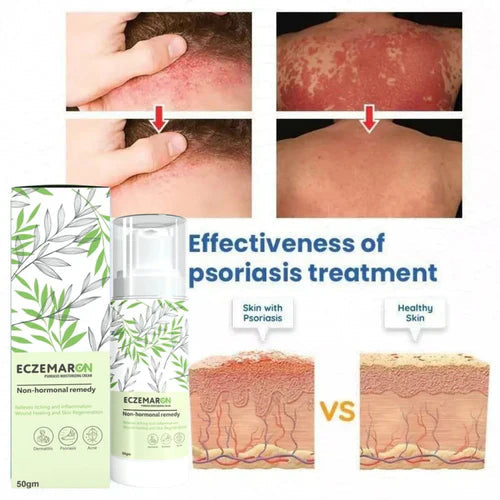 Eczemarone Anti Fungal Cream