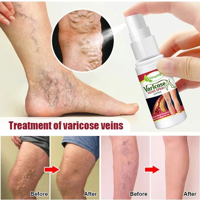 Vein Healing Varicose Veins Treatment Spray 50ml (Pack Of 2)